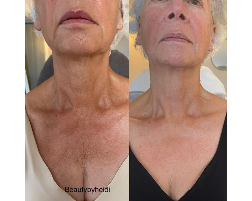 NECK LIFT CREAM. Інтенсивний анти-ейдж крем для шкіри шиї та декольте з 6-ма видами розчинного мікроколагену (колагенові нитки) і 22-ма активними інгредієнтами для клітинного омолодження, 50 гр