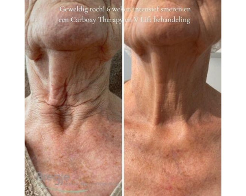 NECK LIFT CREAM. Інтенсивний анти-ейдж крем для шкіри шиї та декольте з 6-ма видами розчинного мікроколагену (колагенові нитки) і 22-ма активними інгредієнтами для клітинного омолодження, 50 гр